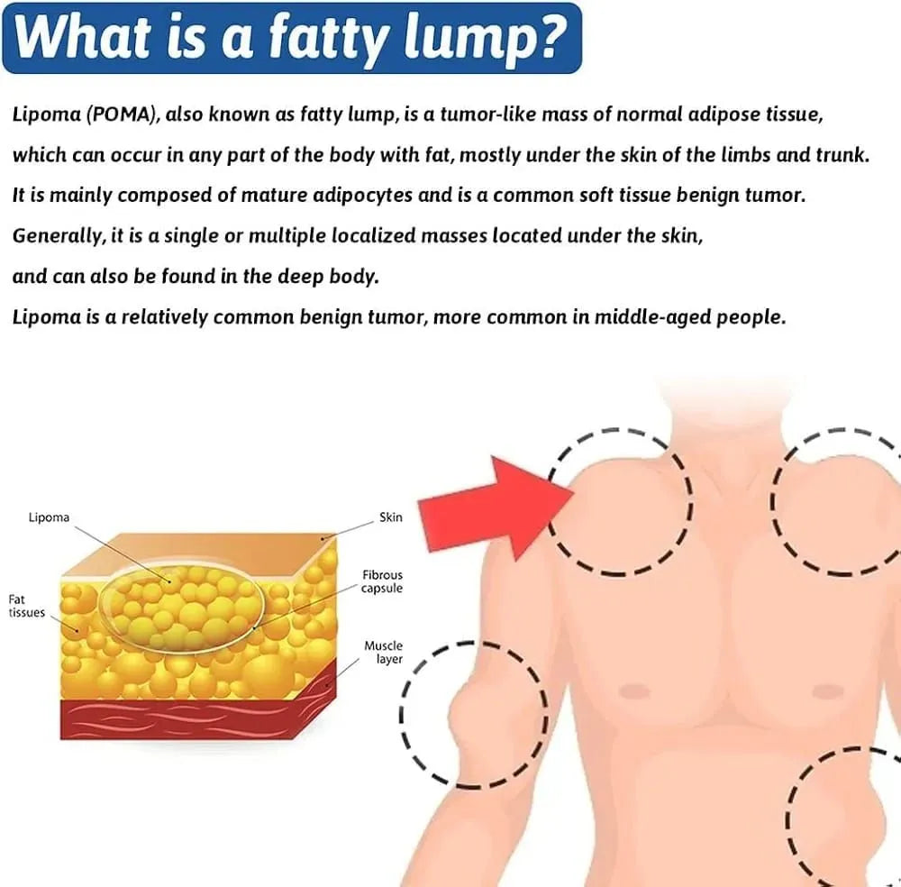 Lipoma Care Cream – Skin Smoothing & Targeted Support Formula