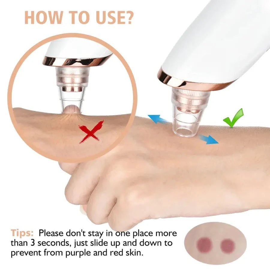 Electric Blackhead Remover – Deep Pore Cleansing & Skin Care Tool